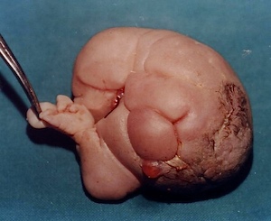 teratoma with hand